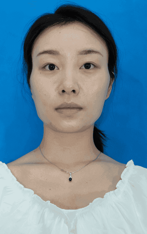 江蘇施爾美整形美容醫(yī)院怎么樣？附拉皮術(shù)后效果對(duì)比及2021價(jià)格表公開(kāi)