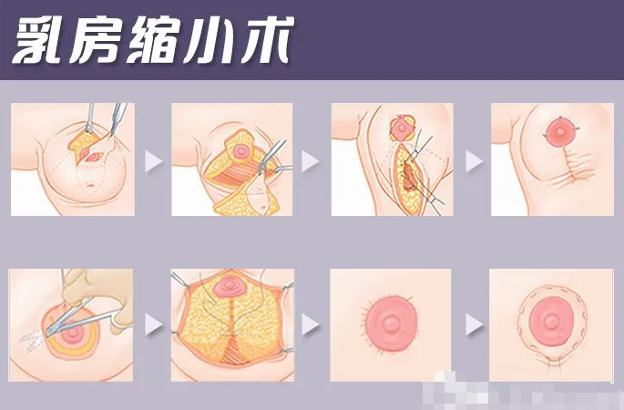 多大可以做乳房縮小手術(shù)，哪些情況適合做乳房縮小手術(shù)?