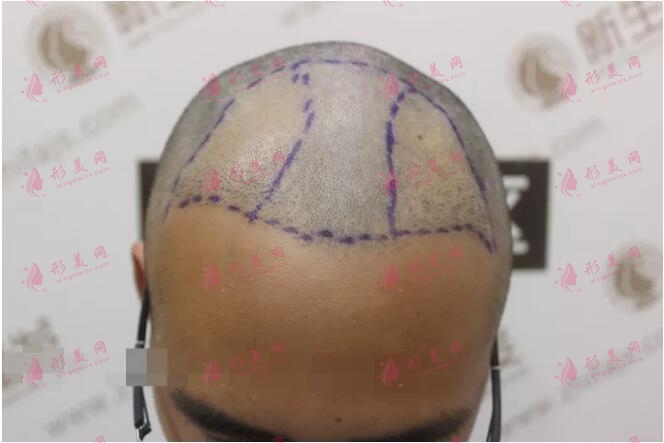 上海九院植發(fā)價格 上海九院植發(fā)價格