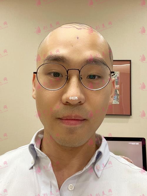 上海九院植發(fā)價格 上海九院植發(fā)價格