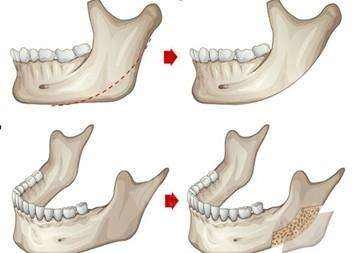 　　磨骨手術(shù)后不會留下疤痕，能有效改善各種臉型?