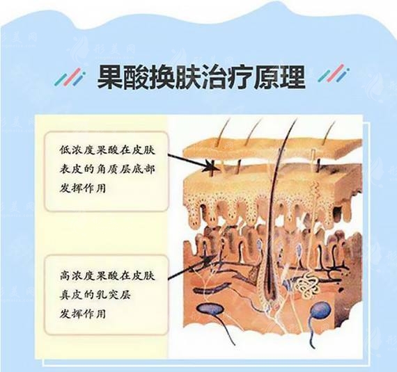 果酸換膚原理