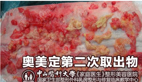 黃廣香奧美定取出修復(fù)價格表：9000元-51000元起