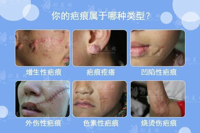 貴陽利美康整形醫(yī)院疤痕科收費價格