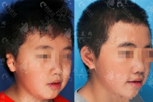 康春雨醫(yī)生耳再造怎么樣