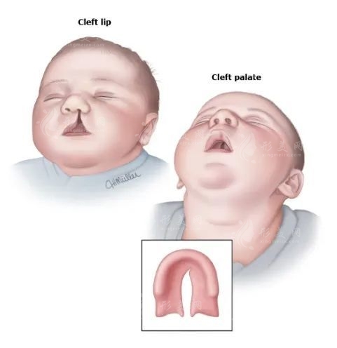 兔唇二次修復哪里醫(yī)院好