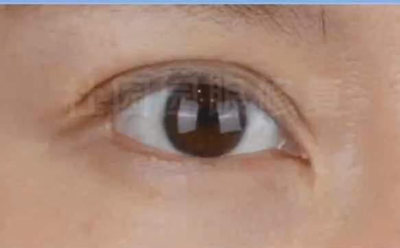 內(nèi)眼角失敗，疤痕明顯？選上海愛(ài)尚麗格讓你找回完美肌膚