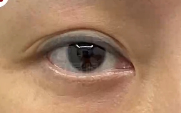 雙眼皮眼尾分叉，上妝易卡粉？看看杜園園醫(yī)生怎么說(shuō)?