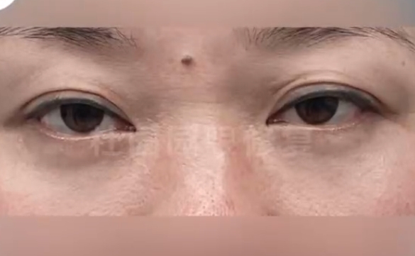 杜園園醫(yī)生揭秘：厭世眼如何實(shí)現(xiàn)眼神大改造？