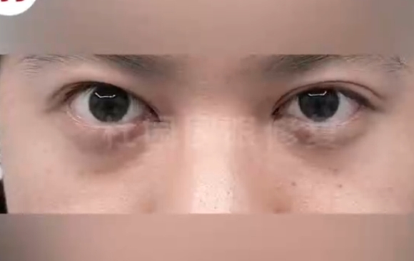告別窄小雙眼，杜園園醫(yī)生幫你實(shí)現(xiàn)雙眼變美