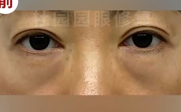 告別下眼瞼疤痕明顯，杜園園醫(yī)生為您還原嬌美雙眸
