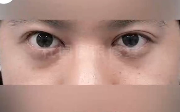 杜園園眼修復(fù)，打造美麗雙眼：告別雙眼皮過(guò)窄煩惱