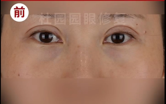 杜園園醫(yī)生修復(fù)案例：雙眼皮不去皮，寬降窄，恢復(fù)自信