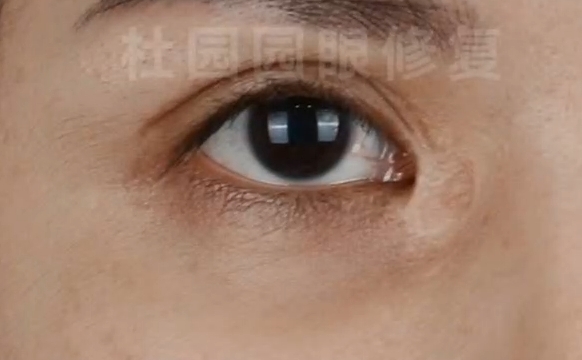 杜園園醫(yī)生內(nèi)眼角片狀疤痕修復(fù)，有問(wèn)題的小伙伴可以參考下喲~