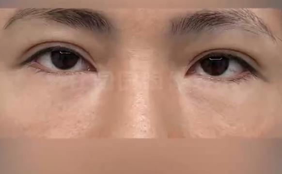 重塑獨(dú)特魅力：上海愛(ài)尚麗格打造驚艷人造雙眼皮