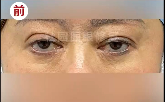 去眼袋失敗，下眼瞼退縮，這該怎么辦？看看杜園園醫(yī)生怎么修復(fù)