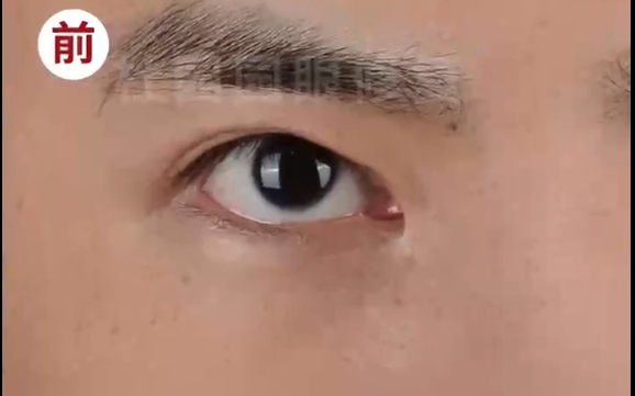 修復(fù)內(nèi)眼角豁口：杜園園醫(yī)生的雙眼皮松脫修復(fù)術(shù)，讓你重獲美麗