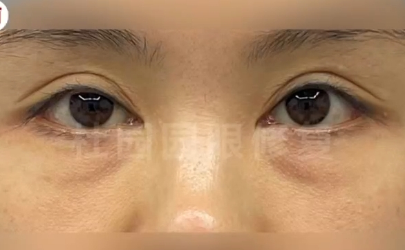 雙眼皮修復(fù)失敗，上海愛(ài)尚麗格杜園園眼修復(fù)案例參考