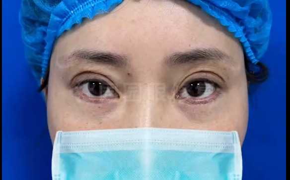 杜園園醫(yī)生分享雙眼皮提眉修復(fù)的成功案例