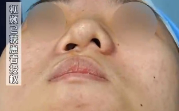 唇裂鼻孔錯(cuò)位難題解決：效果明顯的余文林醫(yī)生案例 