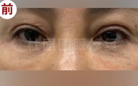 雙眼皮注射脂肪失敗怎么辦？跟隨杜園園醫(yī)生修復(fù)再次美麗