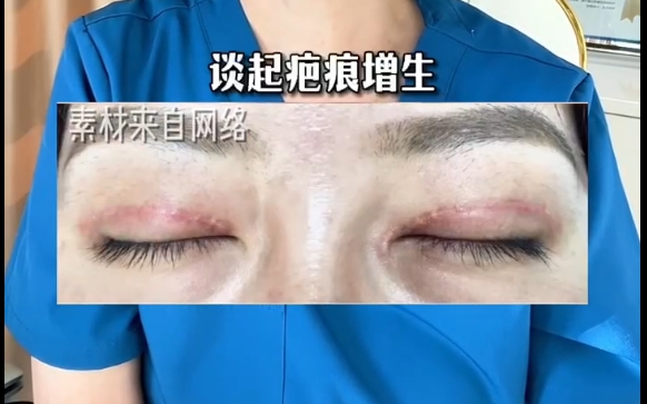 上海愛(ài)尚麗格專家揭秘雙眼皮疤痕手術(shù)增生的真相，不是失?。?>
        </a></li>
       			<li><a href=