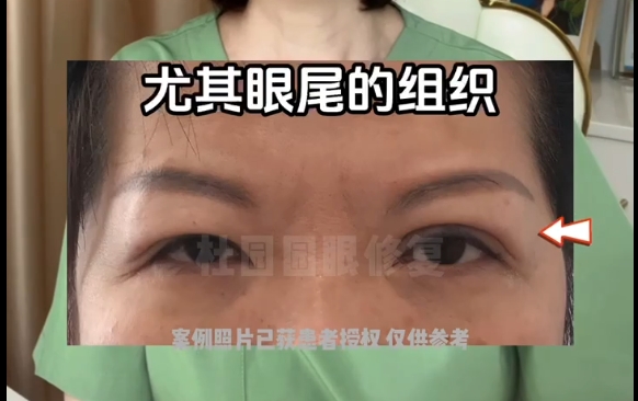 雙眼皮線條過(guò)長(zhǎng)困擾？上海愛(ài)尚麗格醫(yī)院線條修復(fù)專家?guī)湍?>
        </a></li>
       			<li><a href=