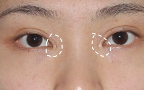包完內(nèi)眼角后為何會出現(xiàn)空心洞？杜園園醫(yī)生解答