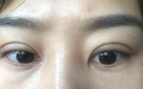 雙眼皮深如何修復(fù)，降窄能解決問題嗎？杜園園醫(yī)生回答你