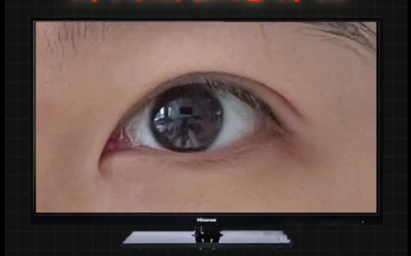 天生狹長的內(nèi)眼角，開大要注意什么？杜園園醫(yī)生解答