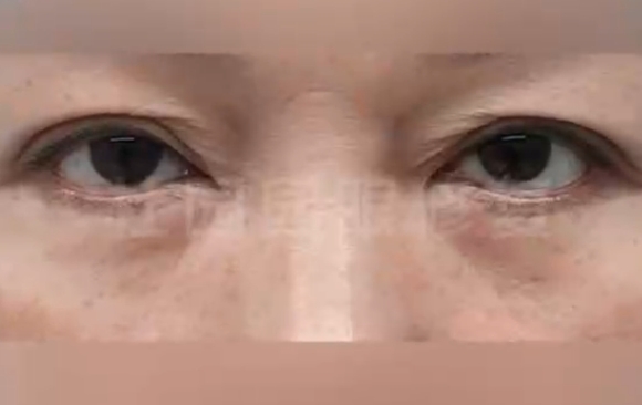 你的雙眼皮有“包子褶”的煩惱嗎？杜園園醫(yī)生案例分享