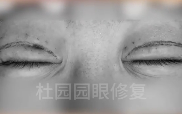 雙眼皮凹陷疤痕，里面發(fā)生了什么？杜園園醫(yī)生在線解答