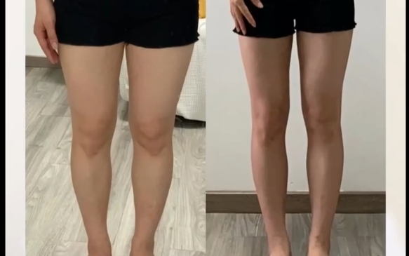 吸脂從胖到瘦的幾個階段，程辰醫(yī)生在線解析