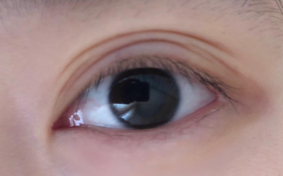 雙眼皮術(shù)后出現(xiàn)多層雙眼皮是什么情況？