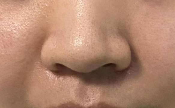 千萬不要外切你的鼻翼，讓你的鼻頭自然縮小
