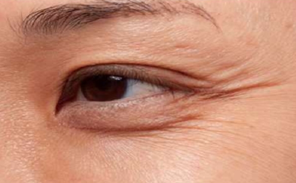 做小拉皮手術(shù)能改善魚尾紋嗎？范飛醫(yī)生告訴你