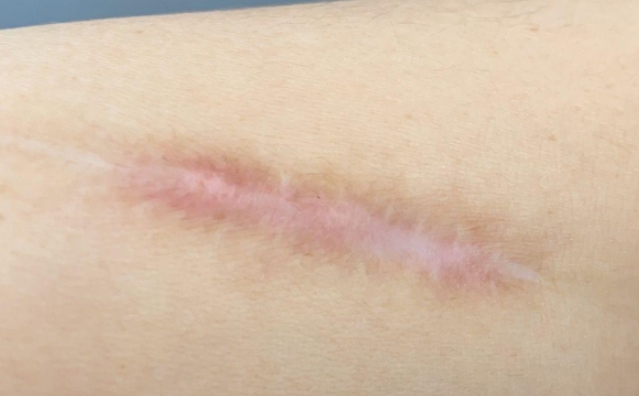 疤痕討厭你做的5個動作，你知道嗎？