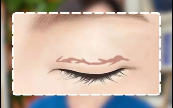 雙眼皮疤痕嚴(yán)重，唯二可以去皮的情況。杜園園醫(yī)生告訴你