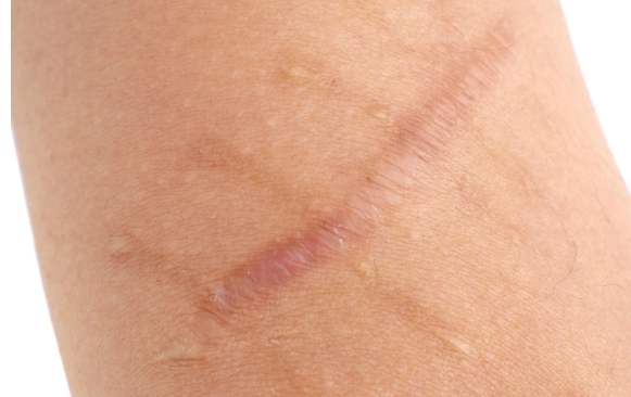 身上的老舊疤痕，能通過治療消失嗎？馮少清醫(yī)生解答