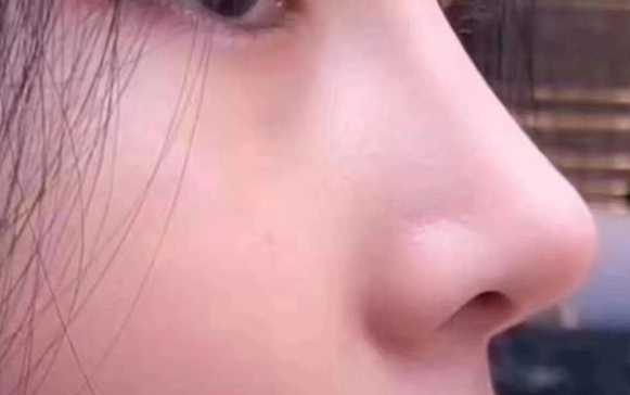 鼻背長痘一直沒有消，醫(yī)生：別扣了，線穿出來了！