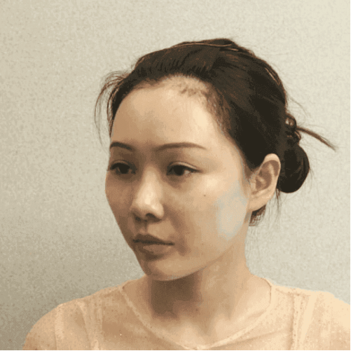 北京八大處磨骨多少錢？2022價(jià)格表曝光+磨骨案例