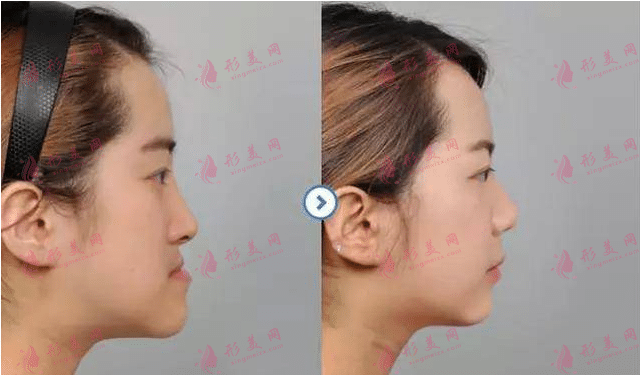 地包天牙齒矯正的最佳年齡和價格是多少？