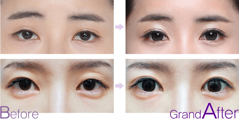 眼睛修復(fù)成功率高嗎?上眼下垂怎么修復(fù)?