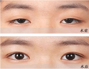 眼瞼下垂的種類有哪些？矯正方法及注意事項分享