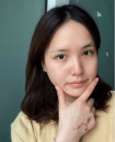 成都軍建醫(yī)院疤痕科怎么樣？附祛疤真人案例一覽