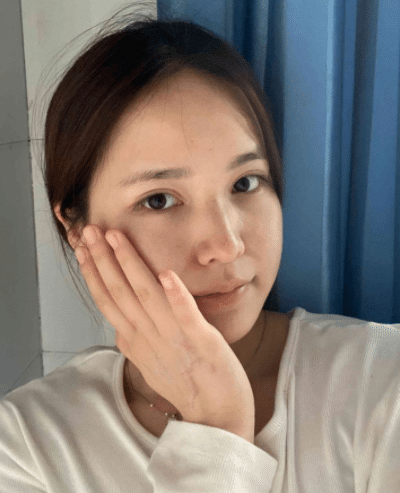 成都軍建醫(yī)院疤痕科怎么樣？附祛疤真人案例一覽