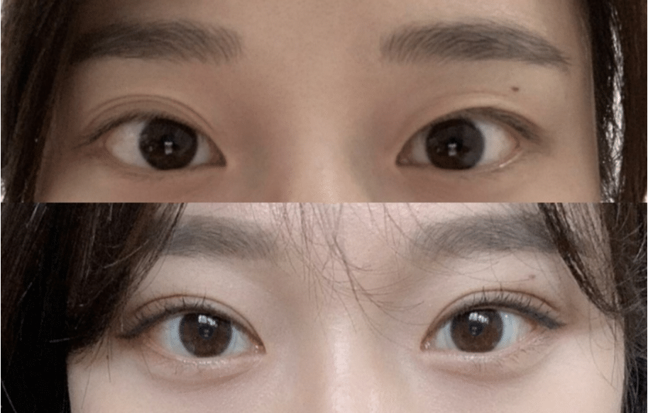 雙眼皮修復(fù)前后對比