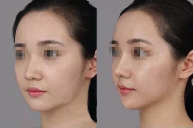 隆鼻術(shù)后對(duì)比