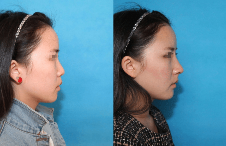 隆鼻術(shù)后對(duì)比