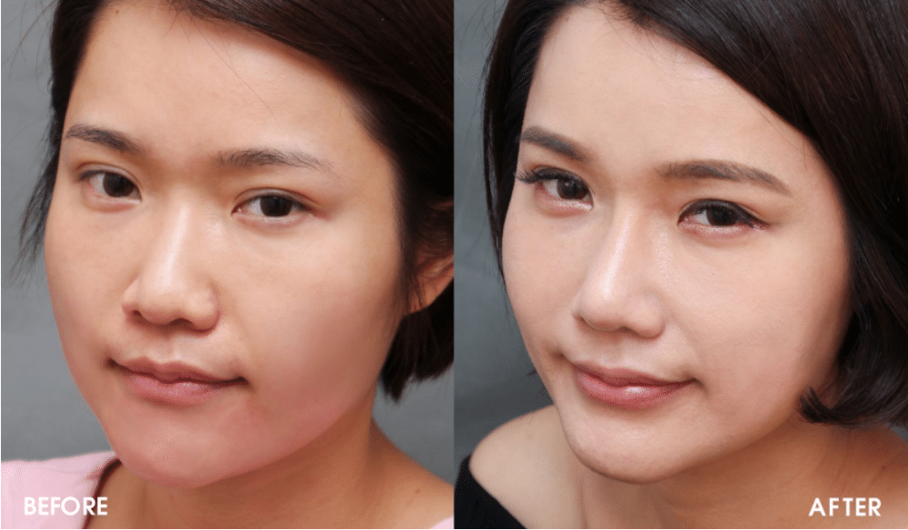 隆鼻術(shù)后對(duì)比